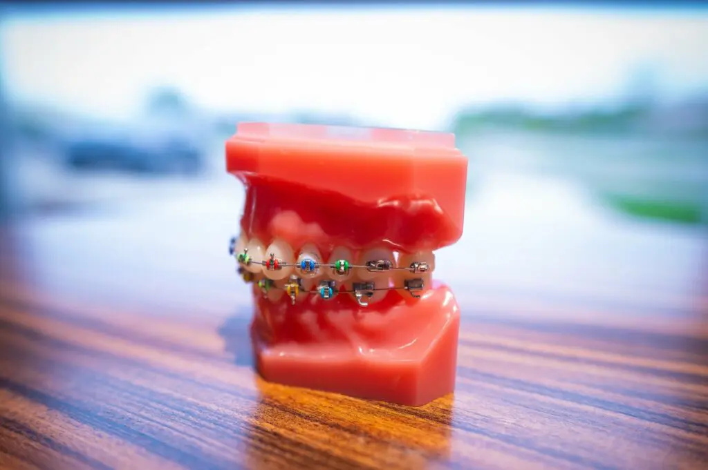 Typodont with metal braces - Align Orthodontics