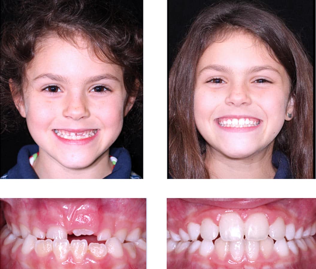 Before and after orthodontic treatment - Align Orthodontics